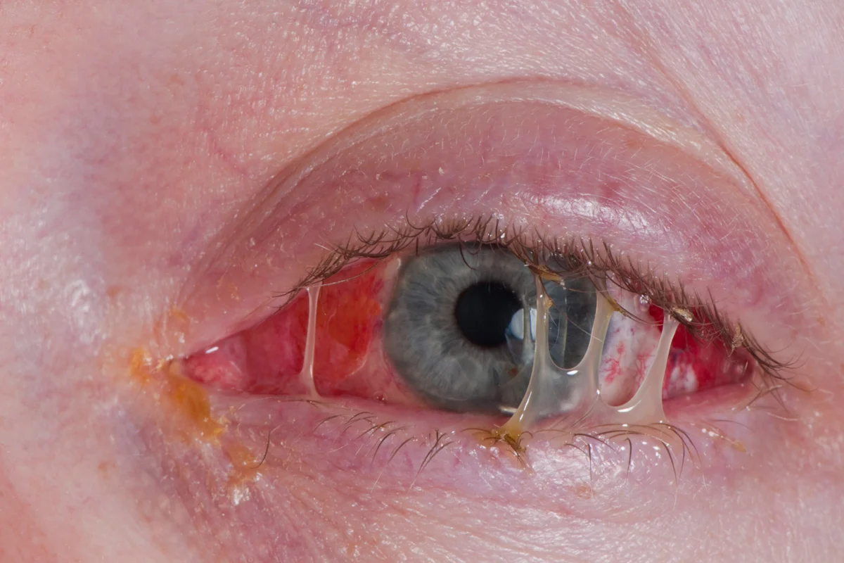 Eye Discharge or Gummy Eye