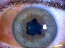 Pupil is enlarged or a strange shape with Uveitis